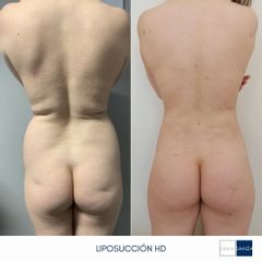 Liposucción - Clínica Sanza