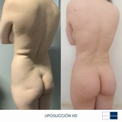 Liposucción - Clínica Sanza