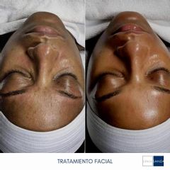 Rejuvenecimiento Facial - Clínica Sanza