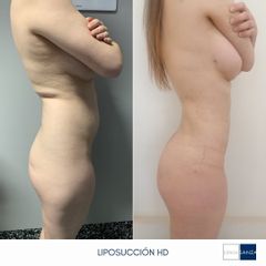 Liposucción - Clínica Sanza
