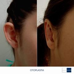 Otoplastia - Clínica Sanza