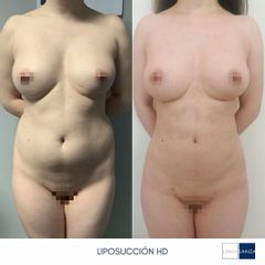 Liposucción - Clínica Sanza