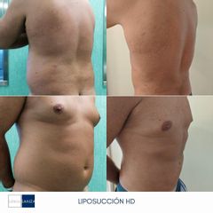 Liposucción - Clínica Sanza
