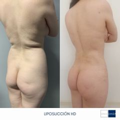 Liposucción - Clínica Sanza