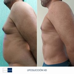 Liposucción - Clínica Sanza