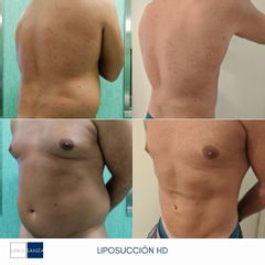 Liposucción - Clínica Sanza