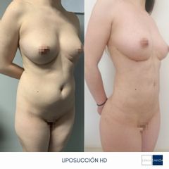 Liposucción - Clínica Sanza