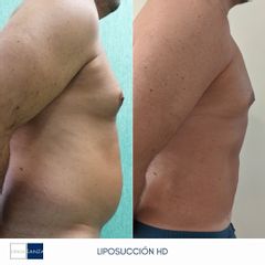 Liposucción - Clínica Sanza