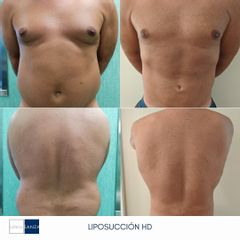 Liposucción - Clínica Sanza