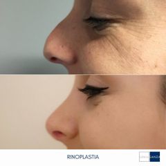 Rinoplastia - Clínica Sanza