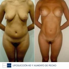 Liposucción y Aumento de pecho - Clínica Sanza