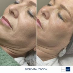 Rejuvenecimiento facial - Clínica Sanza