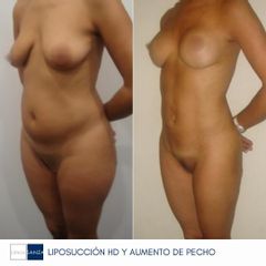 Liposucción y Aumento de pecho - Clínica Sanza