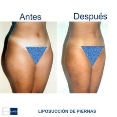 Liposucción - Clínica Sanza