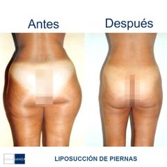 Liposucción - Clínica Sanza
