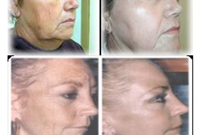 Hilos tensores antes y después - 278979