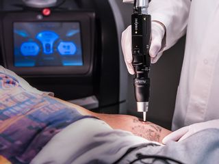 Eliminación tatuaje. Láser Picosure.