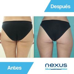 Cavitación - Clínica Nexus