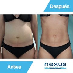 Cavitación - Clínica Nexus