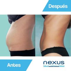 Cavitación - Clínica Nexus