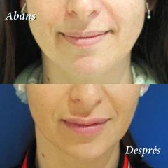Aumento de labios - Clínica Nexus