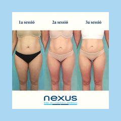 Liposucción - Clínica Nexus
