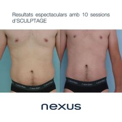 Criolipólisis - Clínica Nexus