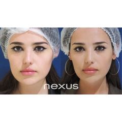 Rellenos faciales - Clínica Nexus