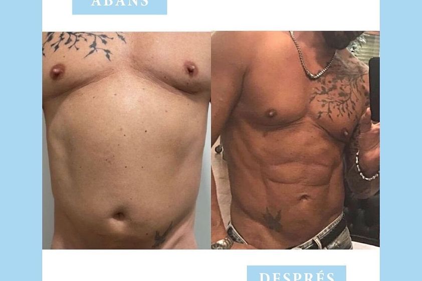 Marcación abdominal antes y después - 842570