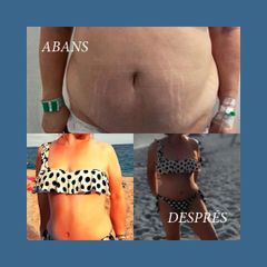 Lipo Vaser - Clínica Nexus