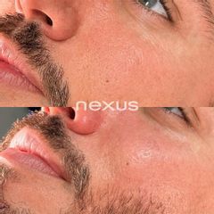 Ácido hialurónico - Clínica Nexus