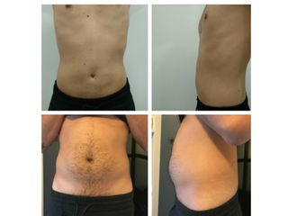 Antes y después Liposucción