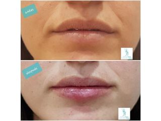Antes y después Hidratación de labios 