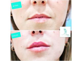 Antes y después Hidratación de labios 