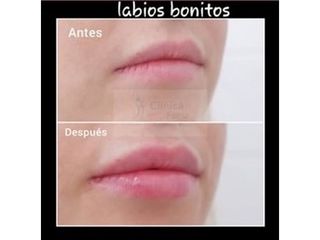 Antes y después Aumento de labios - Clínica Fama