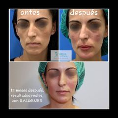 Rejuvenecimiento facial - Clínica Fama