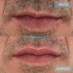 Aumento de labios - Clínica Fama