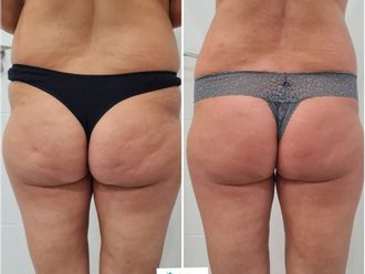 Carboxiterapia antes y después - 790259