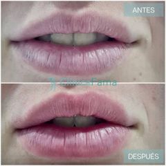 Aumento de labios - Clínica Fama