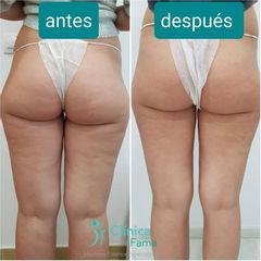 Celulitis - Clínica Fama