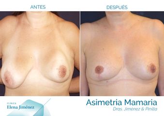 Antes y después Asimetría Mamaria