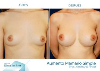 Antes y después Aumento de mamas
