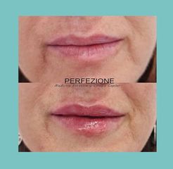 Aumento de labios - Perfezione Clinic