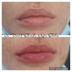 Aumento de labios - Perfezione Clinic