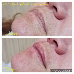 Aumento de labios - Perfezione Clinic