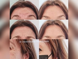 Perfezione Clinic - Rejuvenecimiento facial
