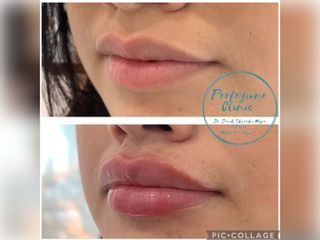 Perfezione Clinic - Aumento de labios