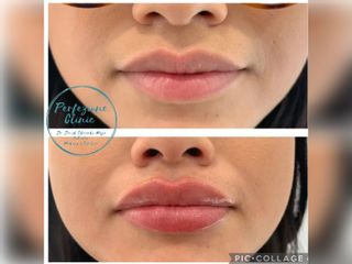 Perfezione Clinic - Aumento de labios