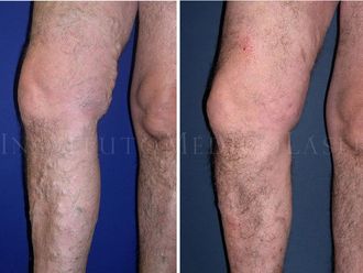 Tratamiento varices - 624882