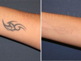 tatuaje brazo antes y despues
